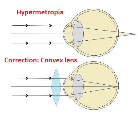 Hypermetropia- sukrajclasses.com